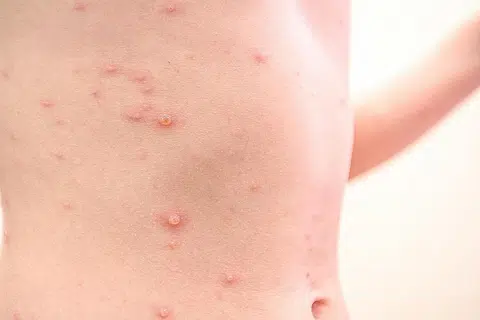 KESAN CACAR AIR: Ruam merah dengan bintik-bintik kemerahan yang sangat gatal di seluruh badan. - Foto ISTOCKPHOTO