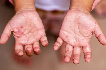 Kanak-kanak golongan paling berisiko tinggi dijangkiti penyakit tangan, kaki dan mulut (HFMD) dengan kebanyakannya akan mengalami bintik-bintik merah pada bahagian tubuh dan ulser dalam mulut. 