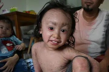 Rafif Afkari Abdul Hadi menghidapi penyakit kulit jarang berlaku, Iktiosis Kongenital, sejak lahir. Penyakit itu menjejas keupayaan tubuh menanggalkan sel kulit mati.
