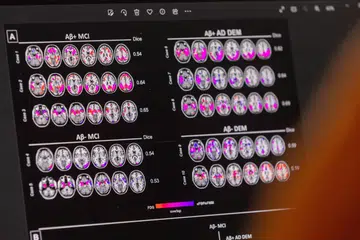 HARAPAN BARU: Sekitar 6.5 juta rakyat Amerika Syarikat dan berjuta lagi di seluruh dunia menghidap Alzheimer yang menyaksikan pesakit hilang daya ingatan dan kemerosotan ketajaman mental. 