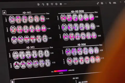 HARAPAN BARU: Sekitar 6.5 juta rakyat Amerika Syarikat dan berjuta lagi di seluruh dunia menghidap Alzheimer yang menyaksikan pesakit hilang daya ingatan dan kemerosotan ketajaman mental. 