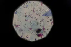 Tuberkulosis, TB, Malaysia