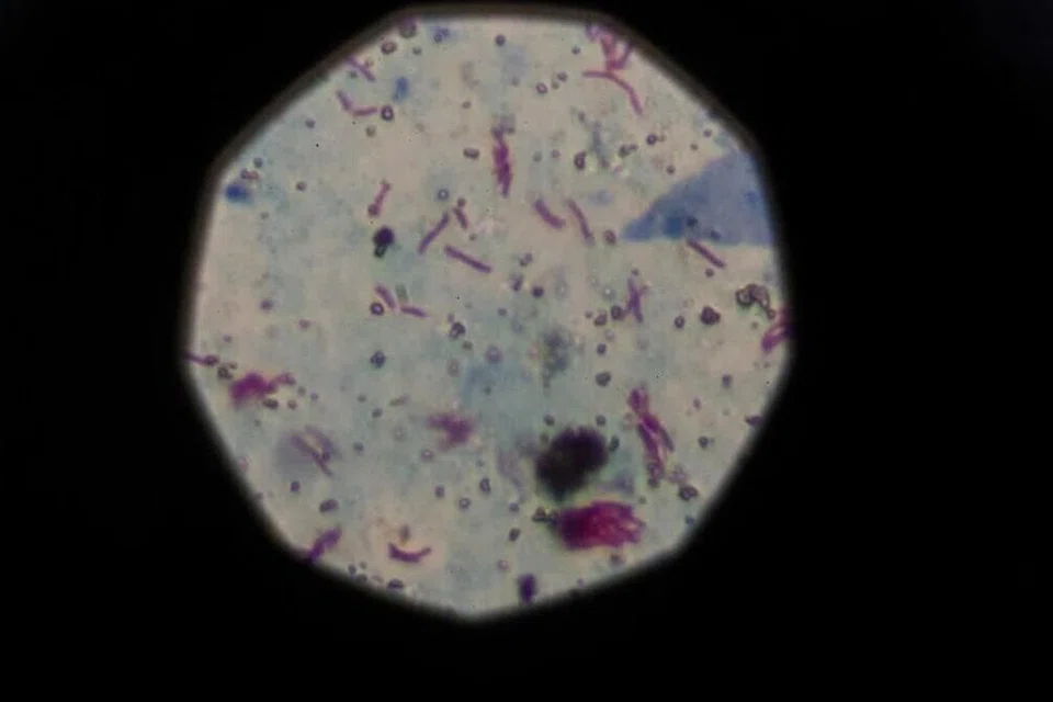 Tuberkulosis, TB, Malaysia
