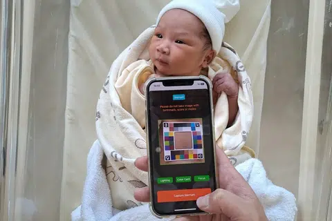 Aplikasi telefon pintar dipacu AI ini membolehkan saringan penyakit kuning dalam kalangan bayi dilakukan secara tanpa bedah. Inovasi ini sekali gus menyokong usaha pemantauan dari rumah, selain membantu mengurangkan kunjungan yang tidak perlu dibuat ke pusat kesihatan. Projek perintis ini dibangunkan menerusi kerjasama antara Hospital Besar Singapura (SGH), Hospital Wanita dan Kanak-Kanak KK (KKH), Hospital Universiti Nasional (NUH), Poliklinik SingHealth dan Poliklinik Universiti Nasional.
