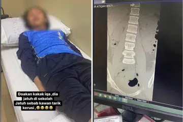 AMAT SAKIT: Seorang anak yang menghidap Palsi Serebral ringan berusia 11 tahun, mengalami kecederaan parah di tulang belakangnya selepas dipercayai kerusinya ditarik semasa di sekolah.