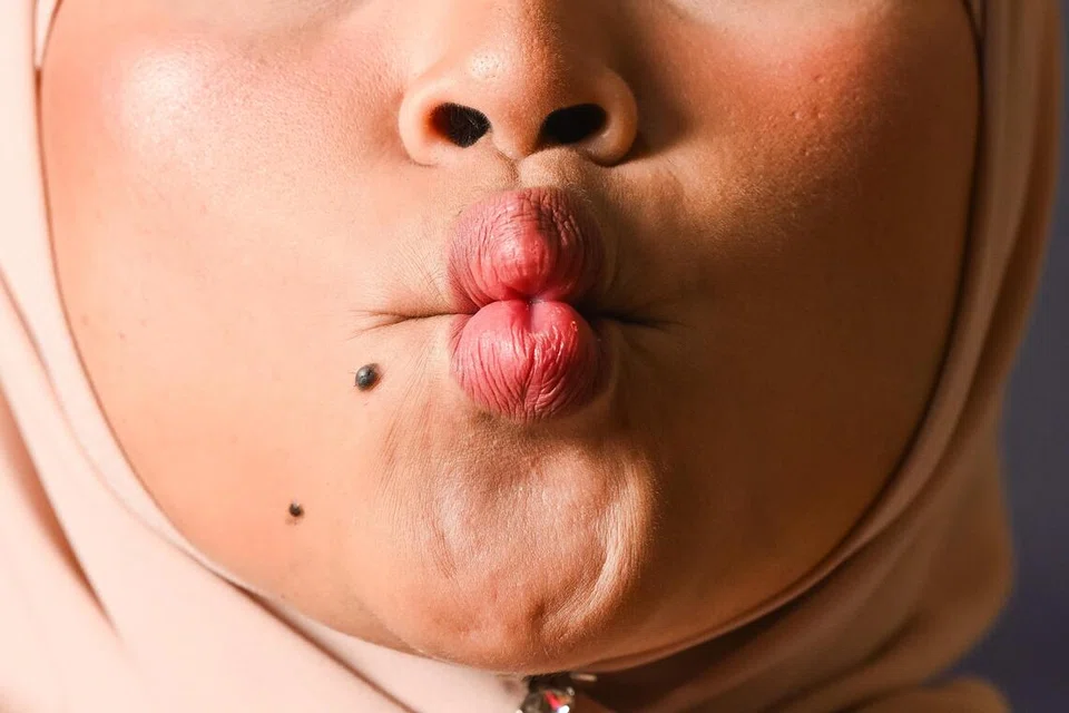 Menguncupkan pipi dan bibir beberapa kali dalam lima minit boleh membantu runcingkan bahagian pipi, sebagai sebahagian yoga muka.