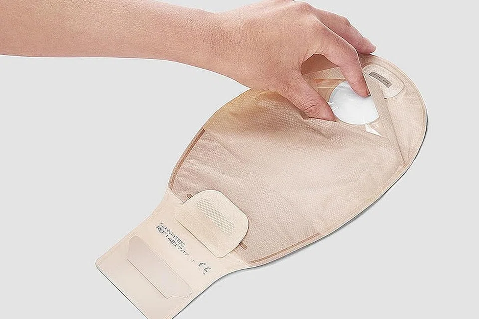 BEG STOMA: Stoma merupakan saluran yang dibuat melalui perut (atau dinding perut) pesakit yang menghubungkan usus dengan permukaan perut. Najis akan keluar dari stoma, ke dalam beg pakai buang. - Foto CONVATEC