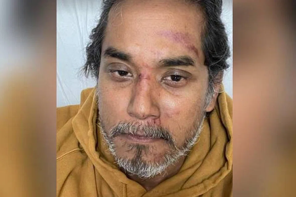 Encik Khairy mengalami kecederaan ringan dan menerima rawatan di hospital berdekatan.