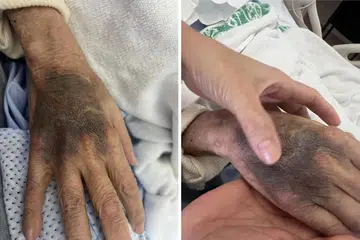 LEBAM: Tangan seorang pesakit Hospital Besar Singapura (SGH) kelihatan dipenuhi lebam dan bengkak.