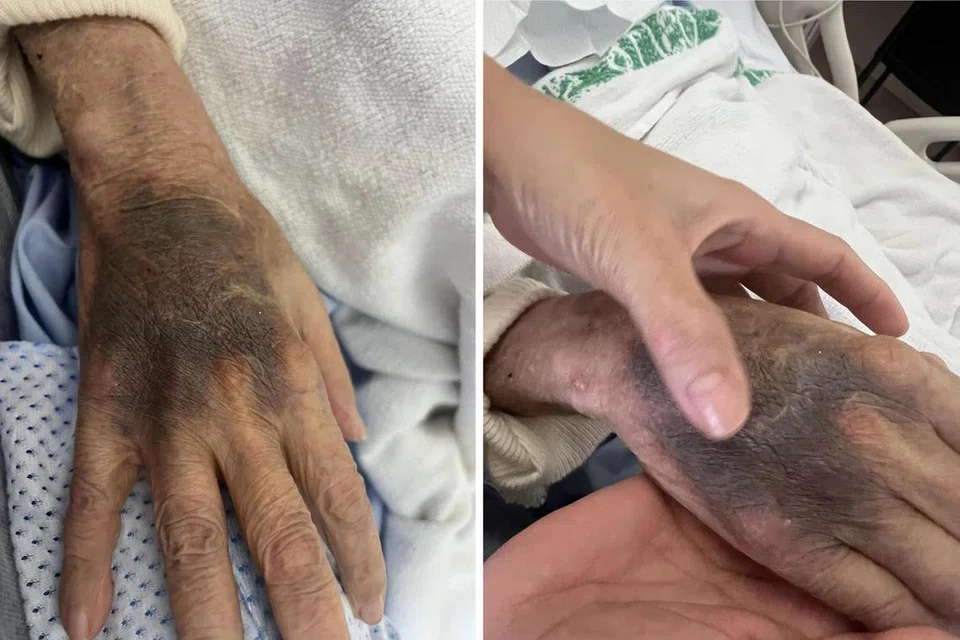 LEBAM: Tangan seorang pesakit Hospital Besar Singapura (SGH) kelihatan dipenuhi lebam dan bengkak.