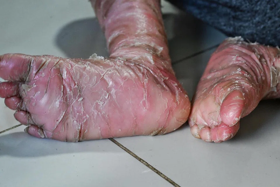 Iktiosis Kongenital, salah satu penyakit kulit jarang berlaku yang tiada penawarnya, hanya perlu diuruskan gejalanya sepanjang hayat. Penyakit ini mengganggu proses penanggalan sel kulit mati, menyebabkan kulit menjadi keras, tebal dan bersisik.