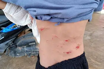 Muhammad Ammar Hakim Sanusi cedera pada bahagian lengan, punggung dan belakang badan akibat digigit dan dicakar seekor kera liar semasa pergi mengaji Al-Quran dekat rumahnya di Taman Madani, Al Muktafi Billah Shah, Dungun, Terengganu, pada 23 Februari. 