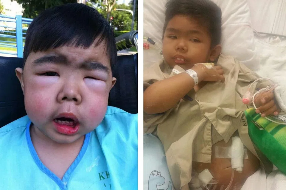 SEBELUM DIALISIS DAN SESUDAH PEMINDAHAN GINJAL: Gambar kiri menunjukkan wajah Hazrie Alisman Norahman yang bengkak sebelum menjalani dialisis. (Gambar kanan) Inilah kesan bedah selepas pemindahan ginjal dijalankan ke atasnya. - Foto-foto ihsan NORAHMAN ABU BAKAR