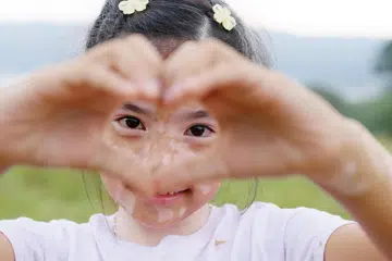 vitiligo, umur, kecederaan kulit, tidak berjangkit