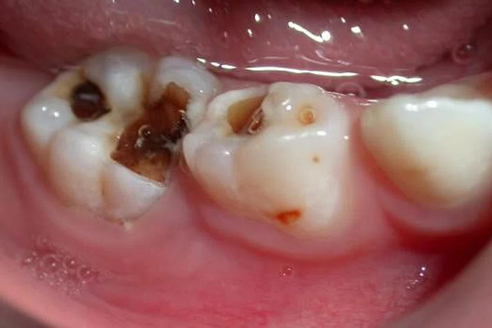 ANAK MENDERITA LAMA: Gigi susu geraham anak tidak akan tanggal awal, malah hanya mula berubah pada usia anak mencecah 10 hingga 12 tahun. Kerosakan seperti ini pada gigi geraham bermakna anak terpaksa menderita akibat sakit dan bengkak selama beberapa tahun sebelum gigi tanggal.