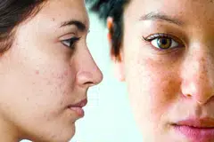 Berbeza dengan pigmentasi kongenital atau keadaan yang dialami sejak lahir seperti tanda lahir, melasma adalah hiperpigmentasi yang diperoleh selepas kelahiran.