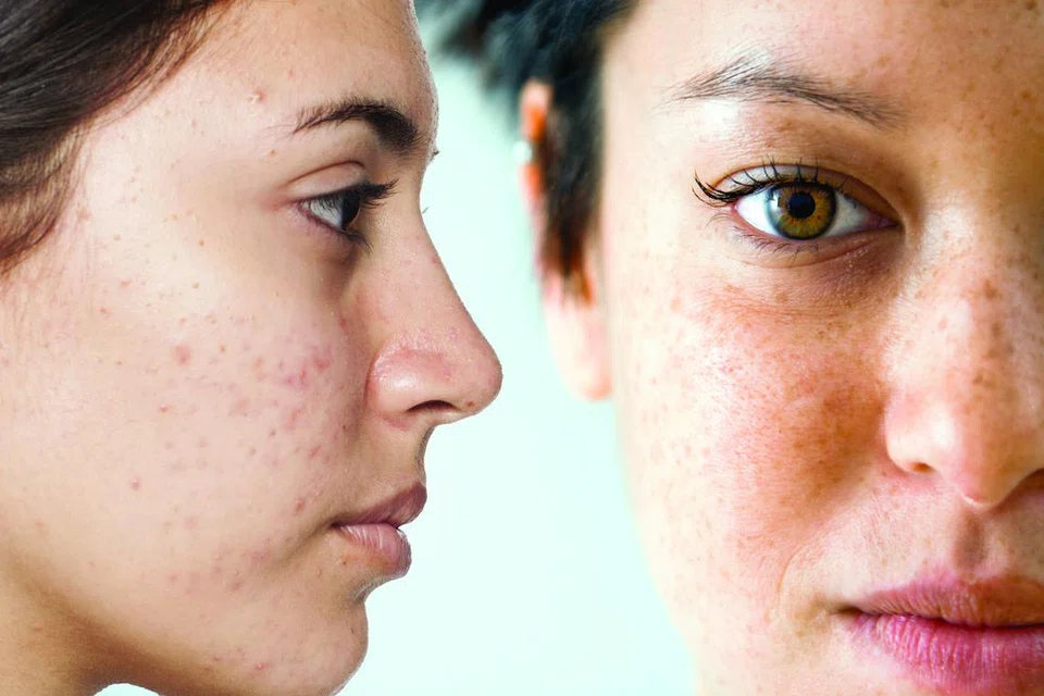 Berbeza dengan pigmentasi kongenital atau keadaan yang dialami sejak lahir seperti tanda lahir, melasma adalah hiperpigmentasi yang diperoleh selepas kelahiran.