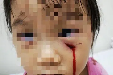 Kanak-kanak 3 tahun luka di muka selepas diserang burung merak peliharaan di Serangoon