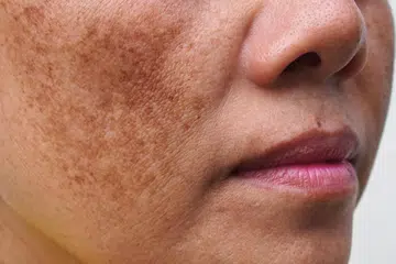 Melasma didorong oleh pelbagai faktor yang melibatkan pengaruh hormon, pendedahan pada ultraungu (UV) dan cahaya tampak, serta keradangan kulit yang berterusan. 