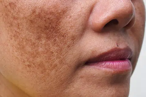 Melasma didorong oleh pelbagai faktor yang melibatkan pengaruh hormon, pendedahan pada ultraungu (UV) dan cahaya tampak, serta keradangan kulit yang berterusan. 