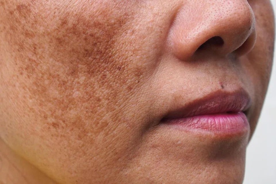 Melasma didorong oleh pelbagai faktor yang melibatkan pengaruh hormon, pendedahan pada ultraungu (UV) dan cahaya tampak, serta keradangan kulit yang berterusan. 