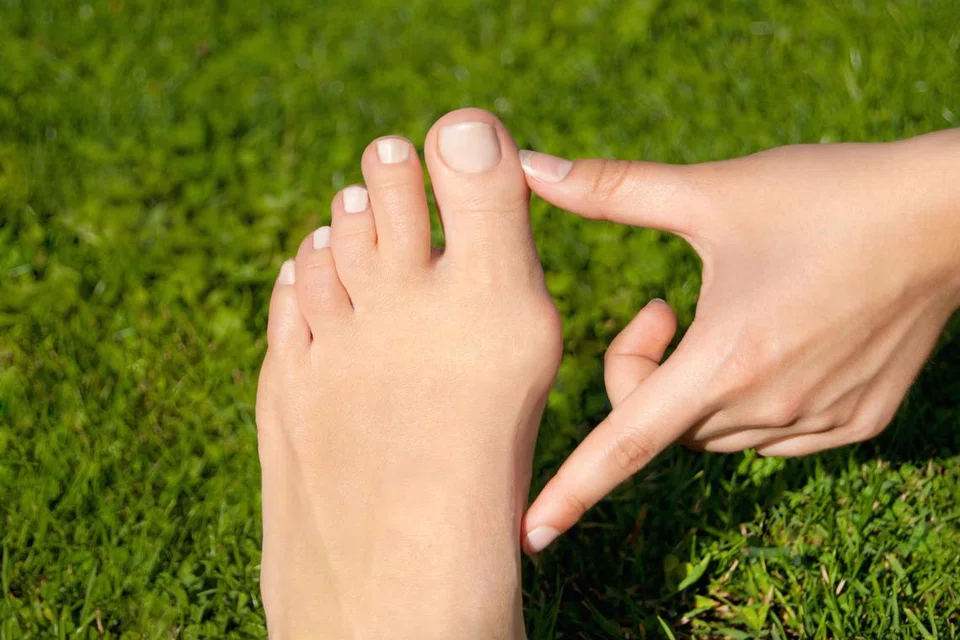 Benjolan tulang atau bunion di kaki boleh menjadi lebih teruk jika terus-terusan menggunakan jenis kasut yang tidak sesuai.