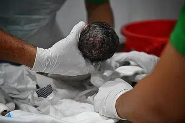 CARA PENGURUSAN: Pakaian pada bayi berusia tujuh bulan ini ditanggalkan sebagai persiapan untuk dimandikan. Balutan dan tampalan yang ada pada bayi itu juga akan ditanggalkan satu persatu jika ia tidak memudaratkan. - Foto BM oleh KHALID BABA
