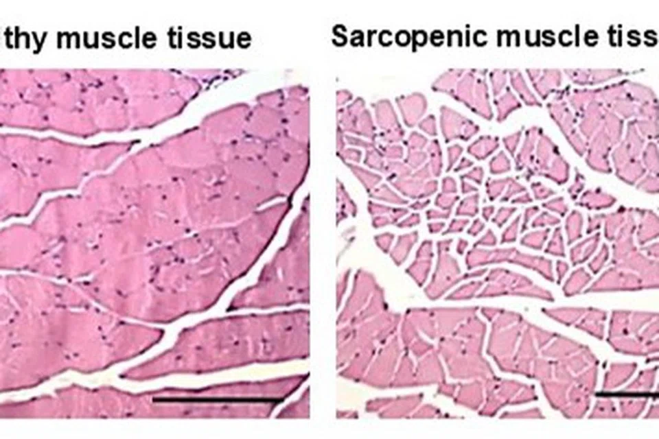Tisu sihat (kiri) berbanding dengan tisu yang terjejas dengan sarkopenia, penyakit kehilangan otot yang berpunca daripada penuaan.