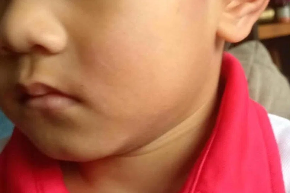 Pipi Isaac Wildan Misan dikatakan bengkak kemerahan akibat kejadian ditampar lelaki berusia 36 tahun.