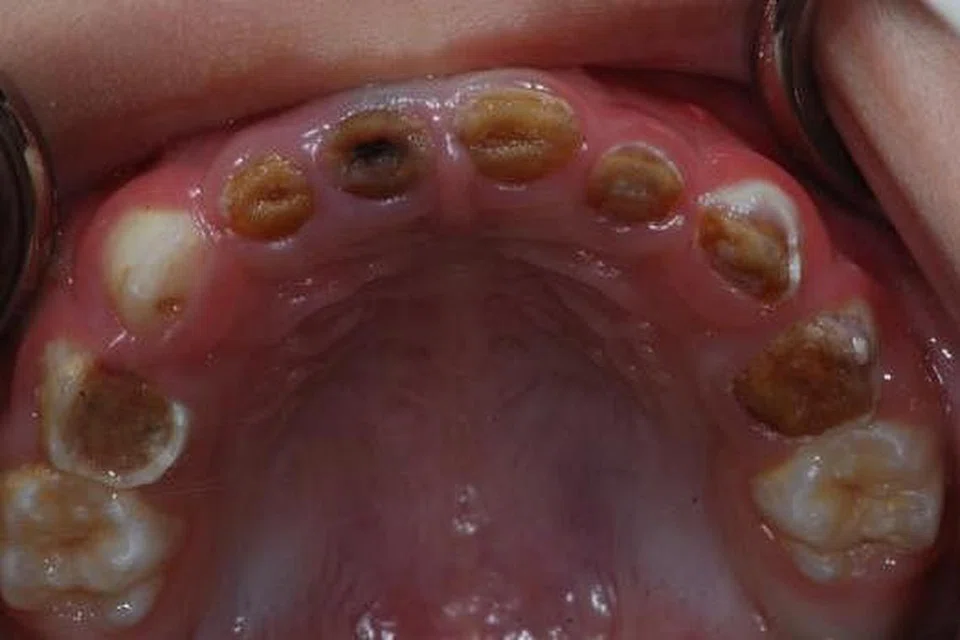 GIGI ANAK ROSAK: Inilah rupa gigi anak kecil yang menghadapi kereputan gigi teruk (severe early childhood caries) akibat minum dengan botol susu ketika waktu tidur. - Foto-foto DR RASHID TAHIR