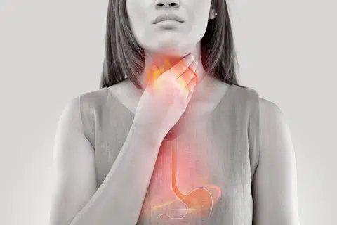 Refluks ditakrif sebagai kandungan makanan atau asid di dalam perut yang naik semula ke esofagus atau sehingga ke bahagian kerongkong. Refluks perkara normal yang boleh berlaku sekali-sekala disebabkan kelonggaran sfinkter (pencerut) di bahagian esofagus bawah.