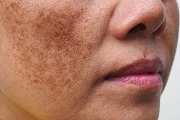 Masalah pigmentasi kulit adalah keadaan apabila warna kulit tidak sekata dengan ada bahagian cerah dan ada yang gelap.