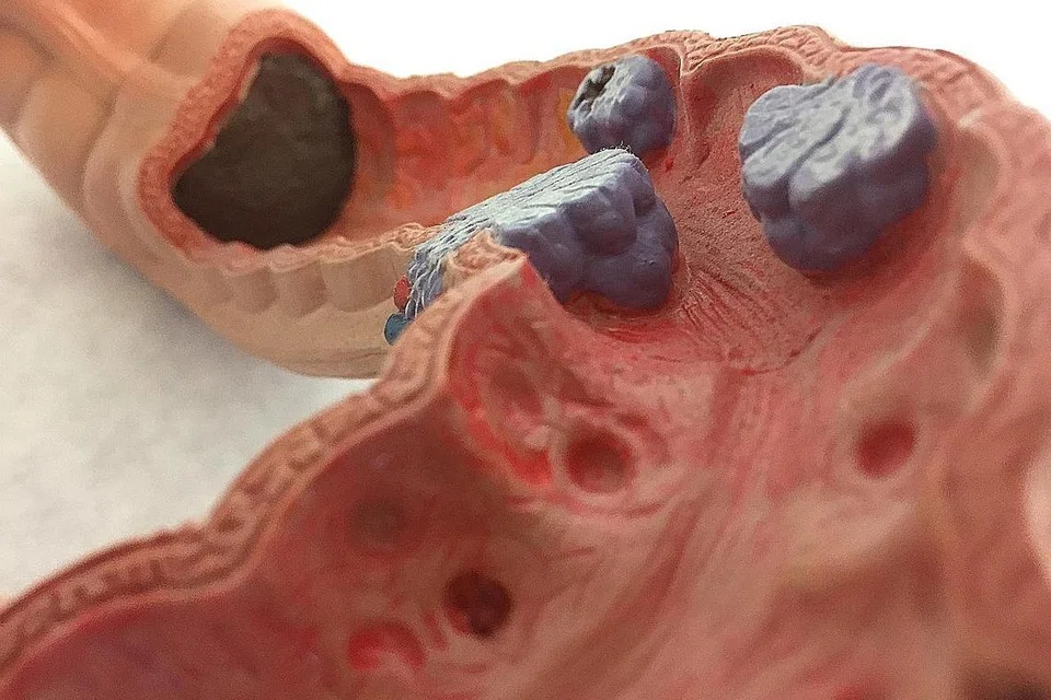 KANSER KOLON: Antara contoh usus manusia yang berpenyakit kanser kolon. - Foto ISTOCKPHOTO