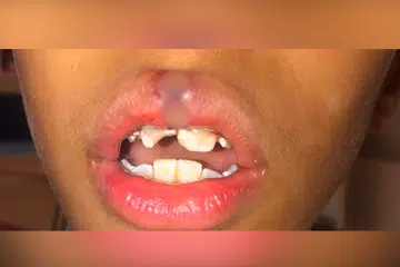 Menurut laporan doktor, pelajar menengah satu itu mengalami kecederaan pada bibir dan giginya.