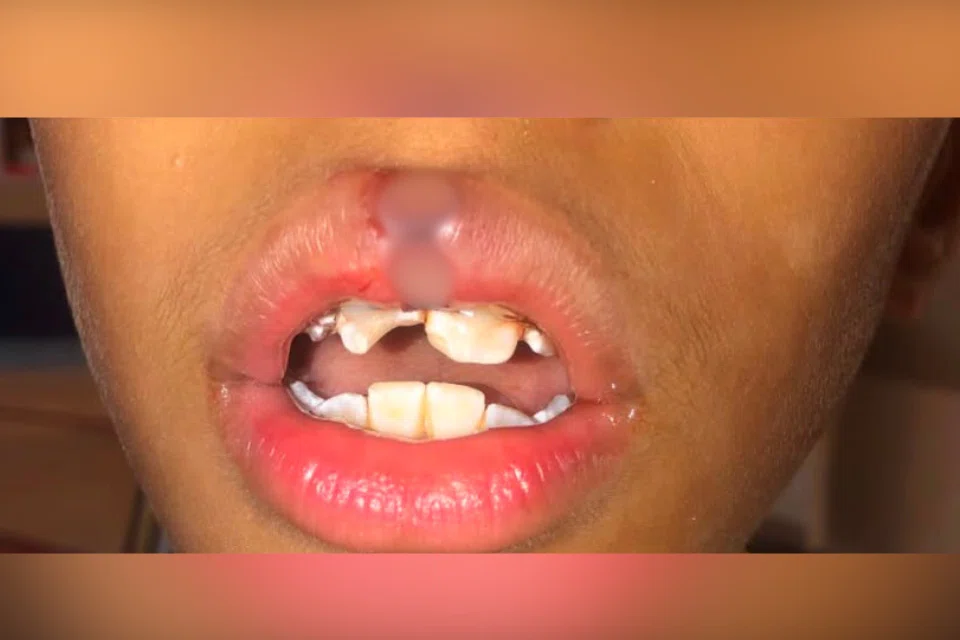 Menurut laporan doktor, pelajar menengah satu itu mengalami kecederaan pada bibir dan giginya.