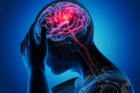 BAGAIMANA IA TERJADI: Strok adalah keadaan di mana berlakunya penyempitan saluran darah ke bahagian otak atau saluran darah pecah. Sebahagian daripada tisu otak akan rosak disebabkan kekurangan bekalan oksigen. - Foto ISTOCKPHOTO