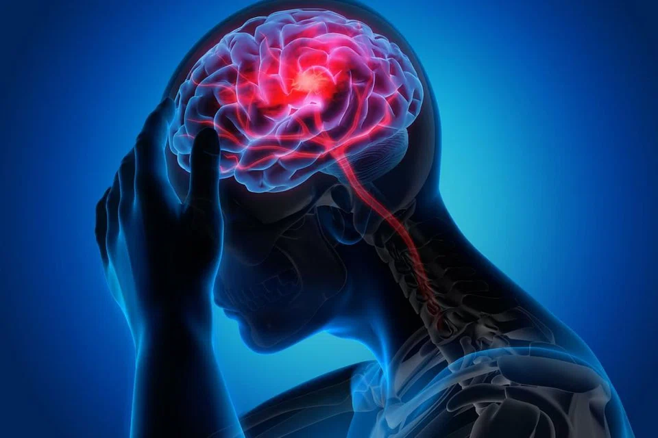BAGAIMANA IA TERJADI: Strok adalah keadaan di mana berlakunya penyempitan saluran darah ke bahagian otak atau saluran darah pecah. Sebahagian daripada tisu otak akan rosak disebabkan kekurangan bekalan oksigen. - Foto ISTOCKPHOTO