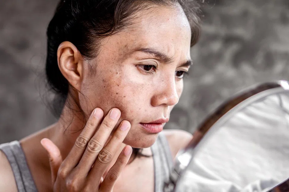 Wajah yang mempunyai bintik-bintik hitam pasti menggusarkan kaum wanita.