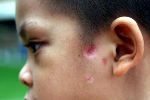 Cacar air ialah penyakit yang sangat berjangkit dan menyebabkan demam dan lepuh kecil yang merah dan gatal pada muka dan badan.