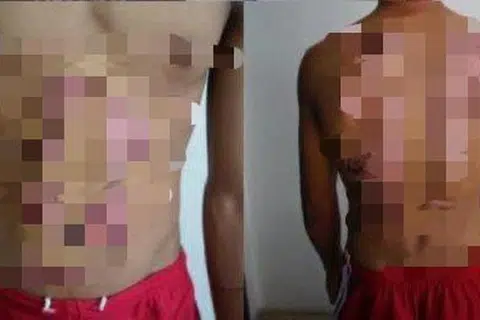 Kesan kecederaan dialami seorang remaja 13 tahun dipercayai akibat didera mengguna sterika, batang besi, sudu panas dan air panas oleh sepasang suami isteri di Keningau, Sabah. 