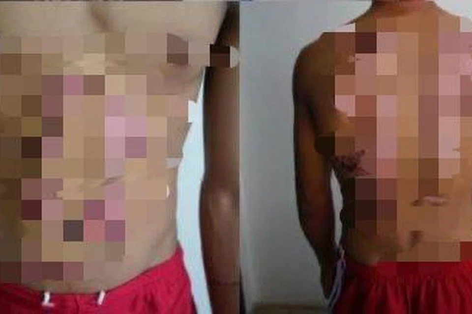 Kesan kecederaan dialami seorang remaja 13 tahun dipercayai akibat didera mengguna sterika, batang besi, sudu panas dan air panas oleh sepasang suami isteri di Keningau, Sabah. 