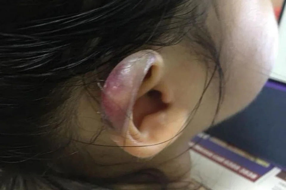 KESAN CEDERA: Ada kesan cedera pada telinga kanan budak perempuan ini. - Foto FACEBOOK CLAUDIA KWAN