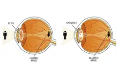 - Sumber: Aboutkidshealth.ca | Grafik: BH