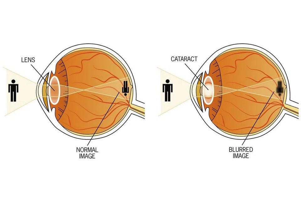 - Sumber: Aboutkidshealth.ca | Grafik: BH