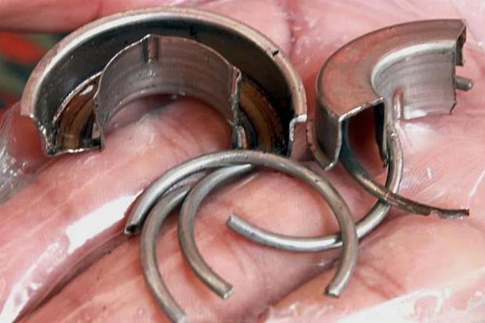 Cincin galas bebola yang dipotong dari zakar lelaki itu di Hospital Pulau Pinang. 