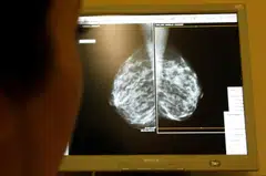 Mammograms, a special type of X-ray of the breasts, is used to detect tumours as part of cancer screening. 