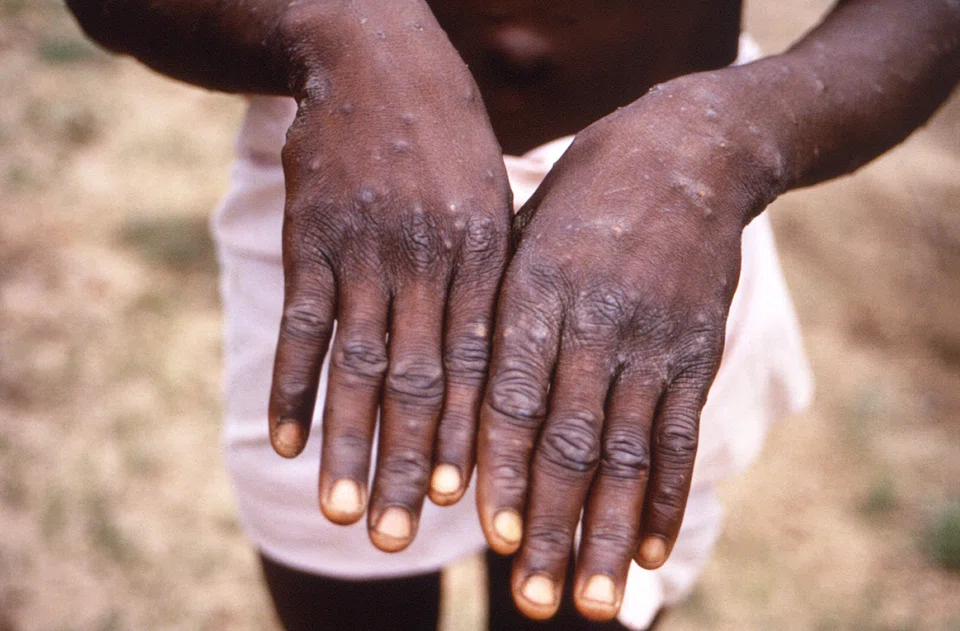 This file photo provided by the US Centers for Disease Control and Prevention depicts the dorsal surfaces of a monkeypox case in a patient who was displaying the appearance of the characteristic rash during its recuperative stage. 