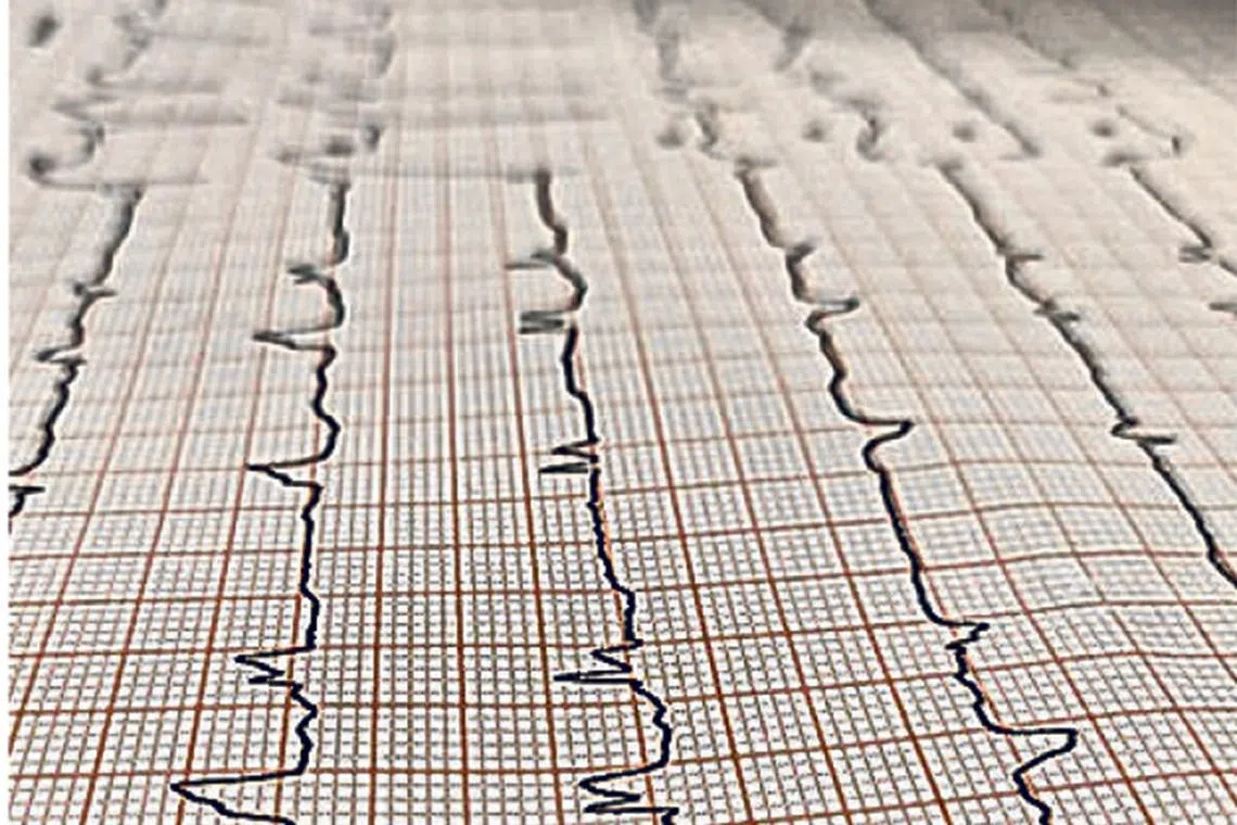 If the CTCA shows normal heart arteries, you can virtually rule out the possibility of any heart attack occurring in the next two years. 