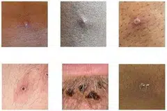 Pictures showing examples of rashes and lesions caused by the monkeypox virus.