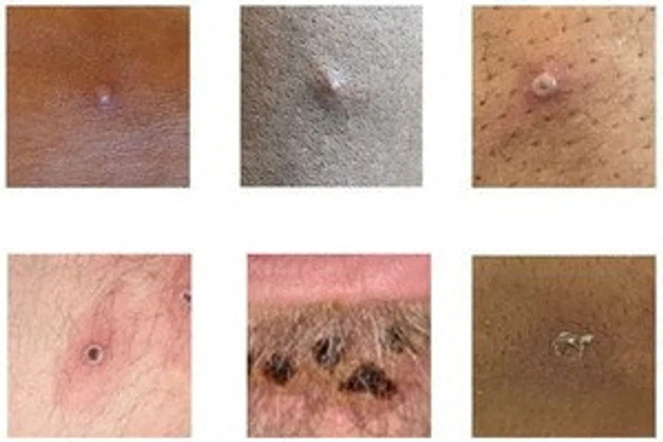 Pictures showing examples of rashes and lesions caused by the monkeypox virus.